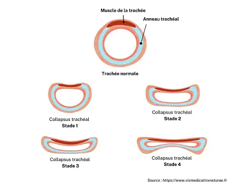 les-4-stades-du-collapsus-tracheal